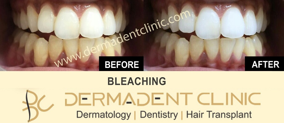 10 Factors That Affect tooth bleaching in Dwarka