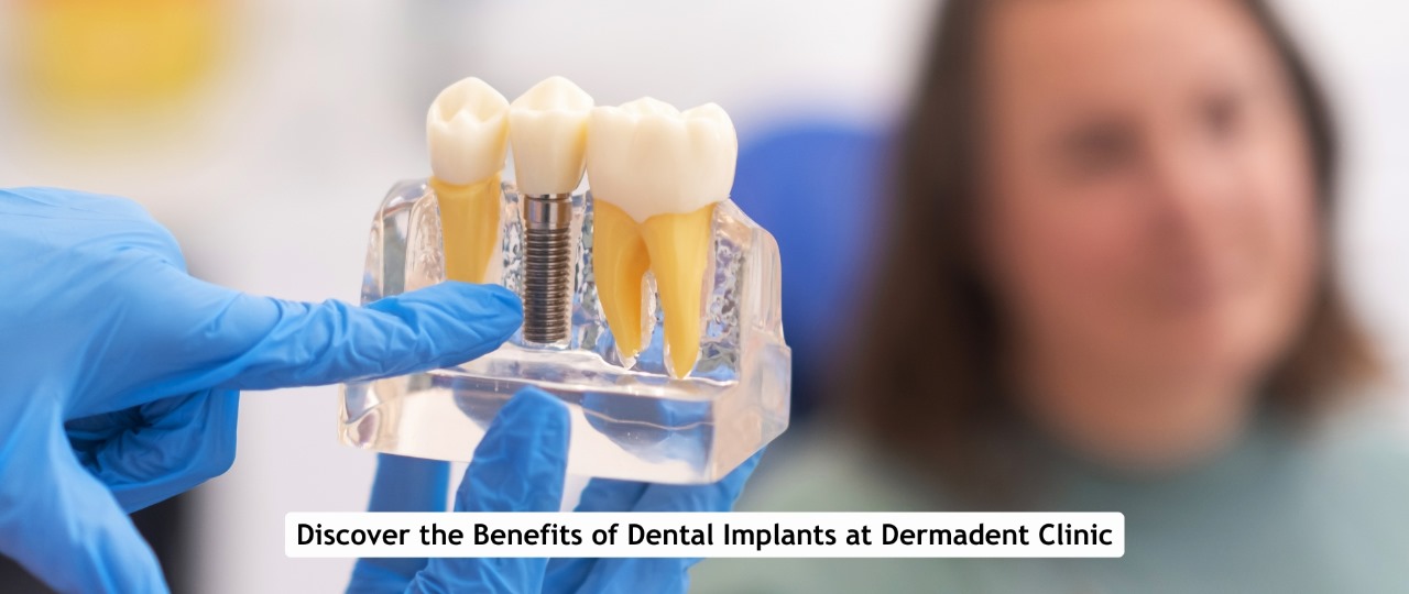 Dental Implants