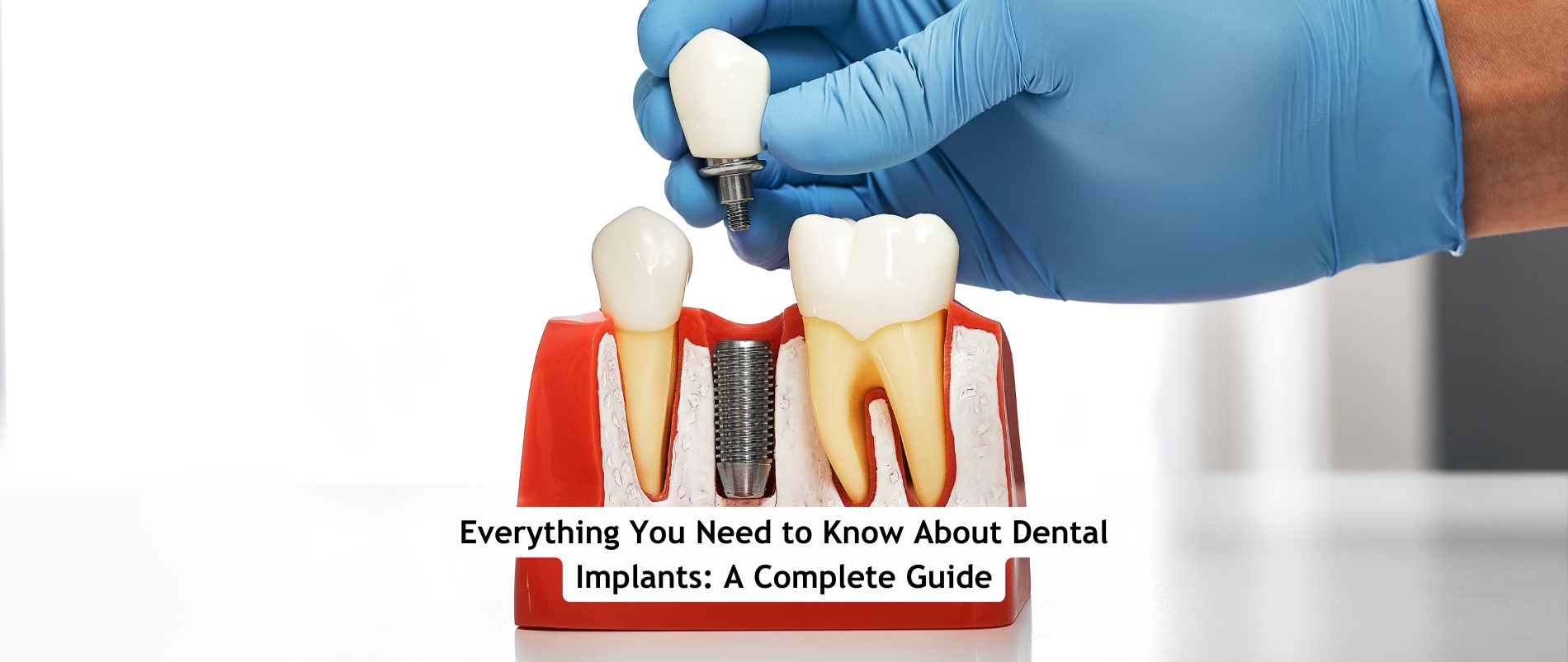 Dental Implants in Udaipur