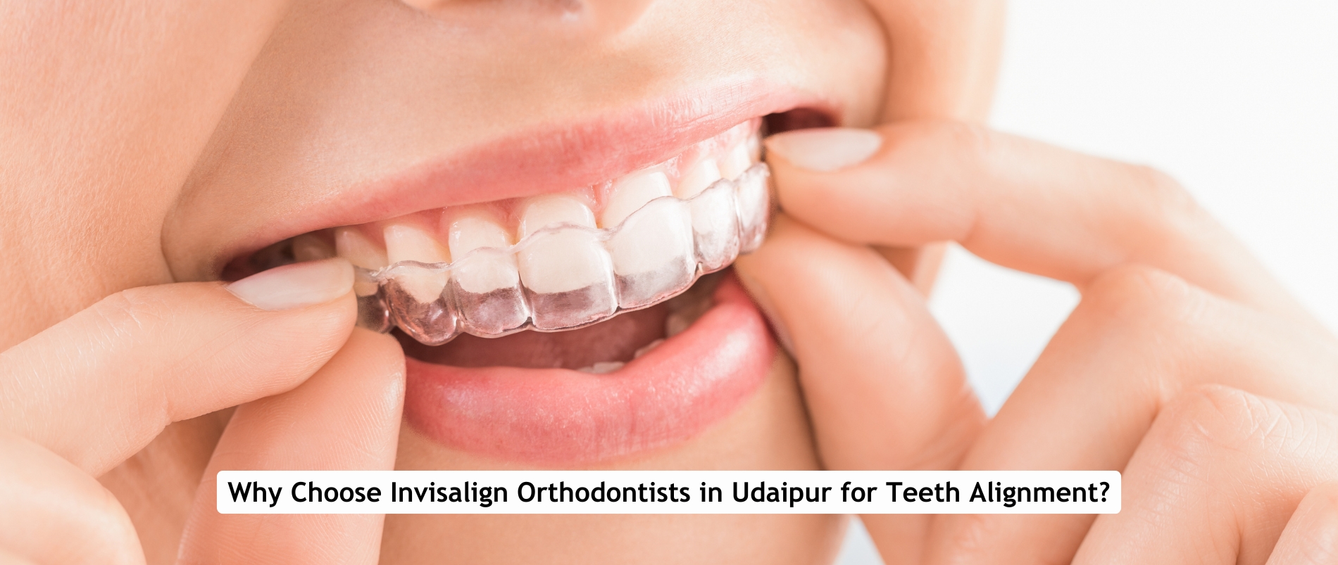 Invisalign Orthodontist Doctors in Udaipur